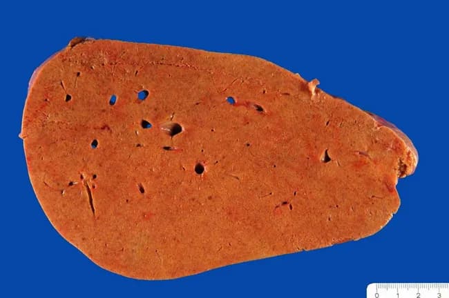Imaging modality: gross pathology photograph of the liver (macroscopic specimen) illustrating diffuse hepatic steatosis characteristic of alcoholic fatty liver disease. The liver appears enlarged and homogenously pale yellow to orange, with a greasy, glistening cut surface due to lipid accumulation within hepatocytes. This macroscopic appearance reflects macrovesicular steatosis, which can progress to steatohepatitis and cirrhosis with continued alcohol exposure. The specimen is from a human liver; the background is a blue operational field used for pathology photography. Notable features include a relatively smooth capsule, uniform parenchymal coloration, and absence of discrete focal lesions in this view. The pathophysiology involves increased fatty acid influx, impaired beta-oxidation, and altered lipid export, with progression influenced by genetic and metabolic factors. Clinically, this pattern correlates with alcohol use disorder and elevated liver enzymes; correlation with history, serology, and imaging is essential. This gross finding establishes a groundwork for histologic confirmation of steatosis, inflammation, and fibrosis. The image is valuable for medical education, teaching hepatology, gastroenterology, and pathology about the spectrum from simple steatosis to steatohepatitis and cirrhosis, and for comparative studies of disease progression. Researchers can use this to illustrate macroscopic phenotypes in alcohol-related liver disease. This image supports diagnosis, education, and research efforts.