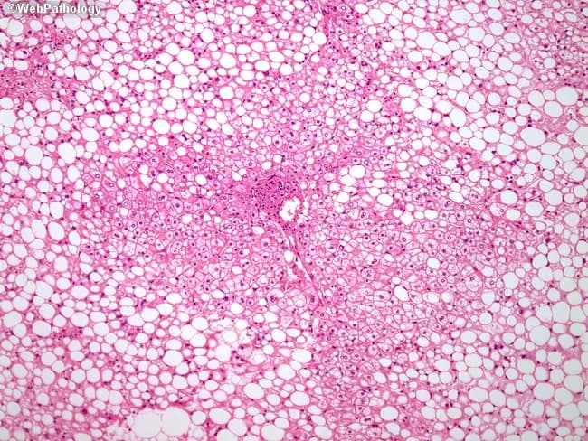 This light microscopy hematoxylin and eosin (H&E) stained liver biopsy section demonstrates alcoholic steatohepatitis with classic macrovesicular steatosis, strongest in acinar zone 3 (centrilobular/perivenular region). Large intracellular lipid droplets displace hepatocyte nuclei to the cell margins, producing a foamy cytoplasm. Hepatocellular ballooning is apparent, with occasional Mallory-Denk bodies representing cytoskeletal inclusions. Neutrophilic and lymphocytic inflammatory infiltrates interrupt hepatocyte plates around damaged cells. Pericellular (chicken-wire) fibrosis encircles hepatocytes, indicating early fibrotic remodeling that may progress to bridging fibrosis and cirrhosis. In early disease, steatosis predominates in centrilobular zones whereas periportal hepatocytes show ballooning with little lipid accumulation. The histologic constellation—macrovesicular steatosis, ballooned hepatocytes, Mallory-Denk bodies, and mixed inflammatory infiltrate with pericellular fibrosis—is highly suggestive of alcoholic hepatitis. Differential considerations include nonalcoholic steatohepatitis when ethanol exposure is uncertain; however, the distribution and cytoplasmic features support alcohol-related injury. Clinically, these findings correlate with substantial alcohol use and risk of progression to cirrhosis and hepatic failure. The image is valuable for education, biopsy interpretation, and research on hepatocellular injury, steatosis patterns, and fibrotic remodeling in alcoholic liver disease.