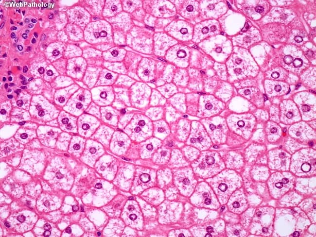 This is a liver biopsy histology image prepared for light microscopy, stained with hematoxylin and eosin (H&E). The primary subject is hepatocytes within the hepatic parenchyma showing features of alcoholic steatohepatitis. Macrovesicular steatosis is evident, with numerous large fat vesicles displacing the cytoplasm. More striking are ballooned hepatocytes, enlarged cells with pale, cytoplasmic clearing and disrupted cytoskeletal architecture. Within several ballooned cells, Mallory-Denk bodies (Mallory hyaline) appear as irregular eosinophilic, hyaline inclusions. The nuclear morphology is variably preserved, with occasionally pyknotic or shrunken nuclei in chronically damaged hepatocytes. The overall cellular morphology indicates hepatocellular injury with cytoskeletal disruption and intracellular inclusions consistent with steatohepatitis. Notably, CK8/18 immunostaining would reveal reduced or absent intermediate filament networks in ballooned hepatocytes, a feature that helps distinguish steatohepatitic ballooning from non-steatohepatitic ballooning seen in viral hepatitis where CK8/18 loss is less pronounced. In alcoholic liver disease, Mallory-Denk bodies and cytoplasmic clearing correlate with ongoing inflammation and progressive fibrosis risk, informing diagnostic significance and clinical management. This image is valuable for education on histologic differentiation between alcoholic steatohepatitis and other causes of hepatocellular ballooning, and for teaching pathology students about steatosis-related cytoskeletal disruption. Correlation with alcohol history and fibrosis staging enhances clinical decision making.