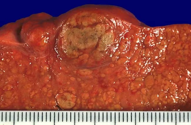 Gross pathology photograph of the liver surface from a case of alcoholic liver disease. The image shows diffuse micronodularity of the parenchyma with a coarse, irregular texture and reddish-brown coloration. Nodularity is predominantly micronodular (<3 mm) due to widespread fibrosis, with occasional larger regenerative nodules that may reflect hepatocyte regeneration during abstinence. The hepatic surface is nodular and uneven, indicating bridging fibrosis and loss of normal lobular architecture. A centimeter-scale ruler is present for size reference, confirming small nodules and expanded fibrous septa. This macroscopic pattern is characteristic of cirrhosis in advanced alcoholic liver disease, where irreversible architectural remodeling yields a nodular, firm liver with altered contour. Pathological significance includes portal hypertension risk, impaired synthetic function, and increased hepatocellular carcinoma risk. Clinically, this appearance correlates with long-standing alcohol exposure, potential ascites, and abnormal liver function tests. The image serves as an educational reference for hepatology, pathology, and medical education, illustrating end-stage liver disease, nodular regeneration, and fibrosis. Differential considerations include cirrhosis from other etiologies (viral hepatitis, biliary disease, nonalcoholic fatty liver disease) and variation in nodularity with disease stage and abstinence. This photograph aids gross-pathology correlation with histology and radiology in teaching cases and supports case-based learning.