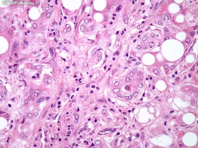 Light microscopy of a formalin‑fixed, paraffin‑embedded liver biopsy stained with Hematoxylin and Eosin demonstrates features of alcoholic liver disease with residual steatohepatitis and cirrhosis. Macrovesicular steatosis is evident in hepatocytes, with hepatocellular ballooning and intracellular Mallory‑Denk bodies representing damaged cytokeratin aggregates. Intermixed neutrophils and lymphocytes comprise the inflammatory infiltrate, including CD4+ and CD8+ T‑cell subsets, consistent with active inflammatory activity. Pericellular, “chicken‑wire” fibrosis surrounds hepatocytes and extends into bridging fibrosis, reflecting advanced architectural distortion and nodularity characteristic of cirrhosis. Lobular disarray and hepatocyte loss contribute to disrupted lobular architecture, while residual portal and central zones display inflammatory activity. These histologic features—steatosis, ballooning degeneration, Mallory‑Denk inclusions, lobular inflammation, and pericellular fibrosis—define a spectrum of steatohepatitis within alcoholic liver disease and correlate with progressive hepatic injury. Clinically, the pattern supports a history of chronic alcohol exposure and bears significance for prognosis, risk of portal hypertension, and hepatocellular carcinoma surveillance. Differential considerations include nonalcoholic steatohepatitis and drug‑induced liver injury; however, Mallory‑Denk bodies and neutrophil predominance strongly favor alcohol‑related injury. Correlate with laboratory data (AST>ALT, elevated GGT) and clinical history for comprehensive assessment. This microcosm illustrates bridging fibrosis, residual cirrhotic nodules, and preservation of some lobular units, guiding staging, prognosis, and therapy decisions in alcoholic liver disease management.