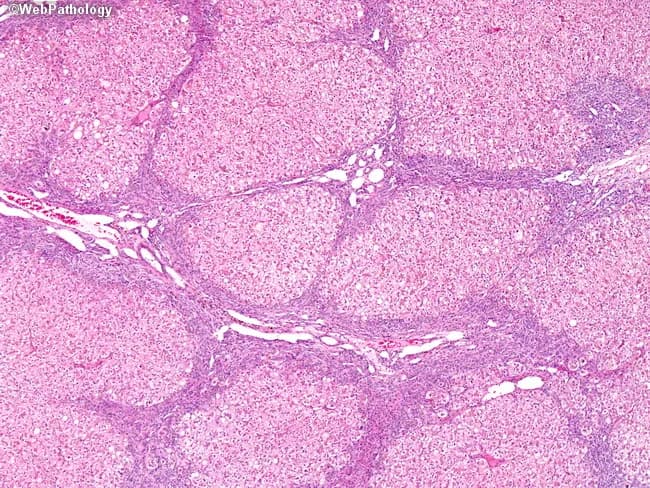 Light microscopy of a paraffin-embedded liver biopsy stained with Hematoxylin and Eosin (H&E) reveals advanced cirrhosis in a patient on long‑term total parenteral nutrition (TPN). Hepatic architecture is distorted by regenerative nodules embedded in a dense fibrous framework; thick fibrous septa traverse the parenchyma and connect portal tracts, producing bridging fibrosis. Within the nodules, hepatocytes are variably damaged, showing cytoplasmic rarefaction and isolated ballooning degeneration. A prominent ductular reaction is seen at the interface between residual hepatocytes and fibrous bands, reflecting biliary-type hepatoportal repair. The overall pattern is consistent with TPN‑associated liver disease comprising steatosis (historically described with TPN) and evolving portal‑to‑parenchymal scarring toward cirrhotic transformation. No discrete mass lesions are identified. This histomorphology supports a diagnosis of cholestatic/hepatocellular injury driven by prolonged parenteral nutrition, with potential clinical consequences including portal hypertension, synthetic dysfunction, and progression to decompensation if TPN exposure persists. Clinically, these findings should be correlated with liver function tests, bilirubin elevation, alkaline phosphatase, and gamma‑glutamyl transferase; imaging and nutrition management should focus on reducing TPN exposure when possible. The pattern must be differentiated from other causes of cirrhosis, including alcoholic liver disease, viral hepatitis, and biliary cholestasis. Educational use includes recognition of ductular reaction and nodular cirrhosis.
