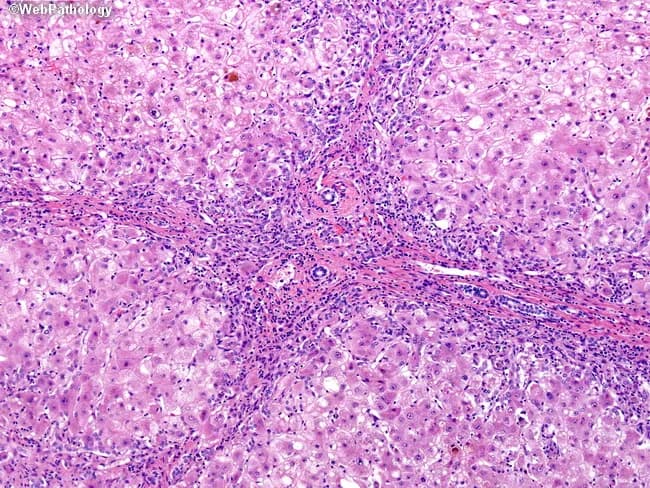 Light microscopy of a formalin-fixed liver biopsy stained with Hematoxylin and Eosin demonstrates advanced Wilson disease–related hepatic injury. The hepatic architecture is distorted by micronodular to early macronodular cirrhosis with regenerative nodules separated by thickened fibrous septa containing lymphoplasmacytic inflammatory cells and ductular reactions. Within the parenchyma, widespread macrovesicular steatosis and hepatocellular ballooning degeneration are evident, accompanied by focal dense eosinophilic cytoplasm and cholestatic changes. Portal tracts show chronic inflammatory infiltrates, interface activity, and occasionally bile duct proliferation. The combination of steatosis, ballooning degeneration, cholestasis, and progressive fibrotic remodeling reflects copper-induced hepatotoxicity in untreated disease. Copper accumulation in hepatocytes drives oxidative injury and disrupted biliary copper export, contributing to hepatocellular damage and fibrosis. These histologic features correlate with clinical laboratory abnormalities and can inform diagnosis, disease staging, and prognosis. In differential diagnosis, similar features can appear in nonalcoholic fatty liver disease or autoimmune hepatitis but the context of Wilson disease (ATP7B mutation) and possible hepatic copper quantification supports etiologic attribution. Clinically, histology complements genetic testing, ceruloplasmin levels, and Kayser-Fleischer ring assessment, guiding chelation therapy and monitoring for progression to cirrhosis, portal hypertension, and hepatocellular carcinoma risk. This histology supports timely intervention and guides multidisciplinary management, including chelation and surveillance strategies.