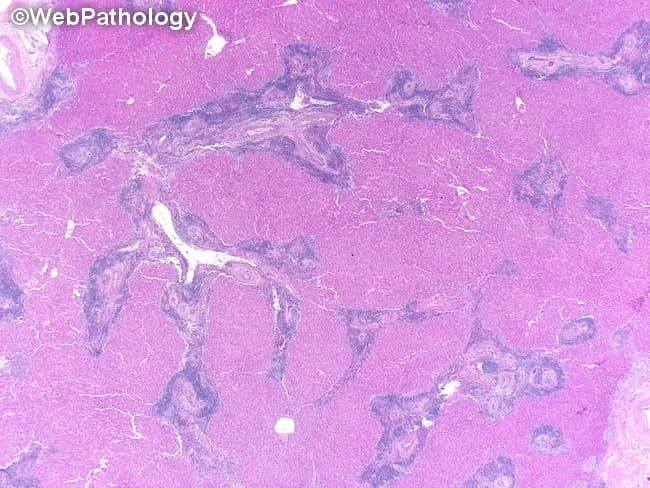 Brightfield light microscopy of a liver biopsy stained with hematoxylin and eosin (H&E). The specimen shows hepatic parenchyma with cords of polygonal hepatocytes separated by sinusoidal capillaries and occasional central veins. The overall lobular architecture appears preserved, with uniform cytoplasmic eosinophilia and round, centrally located nuclei. Portal tracts are not clearly delineated within this low magnification field, but no marked interface activity or interface hepatitis is visible. There is no appreciable steatosis, hepatocellular ballooning, necrosis, or inflammatory infiltrate evident at this magnification. Fibrous septa or cirrhotic nodules are not observed. The tissue appears well preserved with minimal artifact from sectioning. Overall, the histology is compatible with benign hepatic parenchyma in a non-diseased state at this plane of view. This image serves as a reference for normal hepatic architecture and cellular morphology, useful in educational comparisons with diseased liver specimens. Potential clinical applications include baseline histology evaluation, quality control in biopsy processing, and teaching scenarios illustrating hepatocyte cords, sinusoidal arrangement, central veins, and portal areas. Relevant keywords: liver biopsy, hepatic lobule, hepatocytes, sinusoids, central vein, portal tract, H&E, brightfield, normal liver.