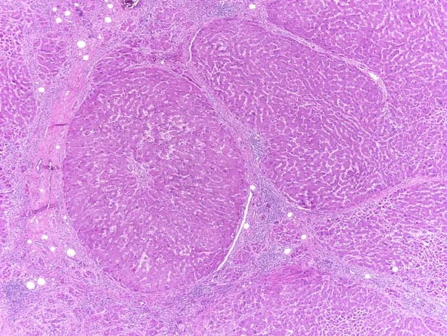 Histology image of cirrhotic liver tissue stained with hematoxylin and eosin (H&E). The hepatic architecture is markedly disrupted by broad fibrous septa bridging across regenerating nodules. The nodular parenchyma comprises thickened plates of hepatocytes organized into irregular lobules, with islands of regenerated hepatocytes separated by dense stromal bands. The nodules appear macronodular, with diameters exceeding the 3-millimeter threshold, corresponding to macronodular cirrhosis; features of micronodular cirrhosis, such as small regenerative nodules, are less evident here. Chronic inflammatory cell infiltrates are present within the fibrous septa and portal tracts, consistent with a long-standing inflammatory process. Vascular remodeling and porto-systemic shunting may be suggested by bridging fibrosis and nodular regeneration. In chronic hepatitis B infection, hepatocytes often show ballooning degeneration and occasional Councilman-like necrosis, though the hallmark is the regenerative nodularity and bridging fibrosis rather than overt tumor. Overall, this image demonstrates the morphological hallmarks of cirrhosis: altered lobular architecture, regenerating nodules, fibrous septa, and chronic inflammatory infiltration. Clinically, such histology correlates with portal hypertension risk, impaired synthetic function, and elevated hepatocellular carcinoma risk in chronic HBV carriers. This slide provides a robust reference for teaching nodularity classification and cirrhosis staging from a histopathologic perspective.