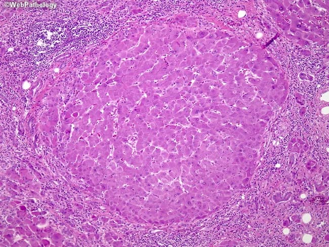 This liver biopsy histology, stained with Hematoxylin and Eosin, is presented at low power to emphasize cirrhotic nodularity produced by chronic hepatitis B infection. The hepatic parenchyma shows regenerative nodules separated by fibrous septa, creating a mosaic architecture typical of cirrhosis. Nodules are micronodular (<3 mm) and macronodular (>3 mm), reflecting different stages of fibrogenesis and nodular regeneration. Within the nodules, hepatocytes form plates and cords with preserved central venules in some regions, while surrounding fibrous tissue contains chronic inflammatory infiltrates and a ductular reaction indicating ongoing bile ductular proliferation. The interface between nodules and septa is irregular, with disruption of normal lobular architecture and portal tract remodeling. Staining highlights eosinophilic cytoplasm of regenerating hepatocytes, occasional binucleation, and prominent vascular channels within expanded fibrous stroma. Overall, the image supports a diagnosis of cirrhosis secondary to chronic hepatitis B, with implications for portal hypertension, hepatic insufficiency risk, and hepatocellular carcinoma surveillance. This histologic pattern informs fibrosis staging (e.g., advanced F4) and guides clinical management, including antiviral therapy optimization, risk stratification, transplant evaluation, and prognosis in HBV-related liver disease. Correlative clinical data, laboratory markers, and imaging are recommended to complete the assessment and monitor response to therapy over time.