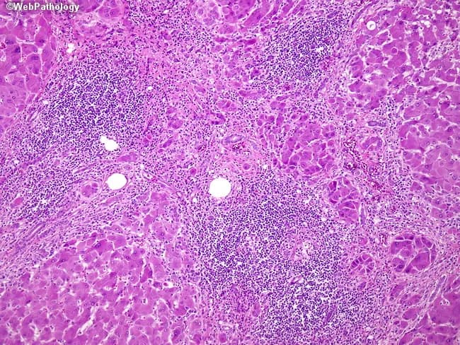 Imaging modality: Light microscopy of a liver biopsy stained with hematoxylin and eosin. The histologic specimen demonstrates established cirrhosis with nodular regeneration. The hepatic parenchyma is reorganized into regenerative nodules encircled by dense fibrous septa, reflecting bridging fibrosis. Nodules are predominantly micronodular (<3 mm) in classic early chronic hepatitis B–related cirrhosis, though macronodular (>3 mm) foci may be present as disease progresses. The nodules are composed of regenerating hepatocytes arranged in thickened cords with disrupted lobular architecture; surrounding scar tissue contains portal-type inflammatory infiltrates and dense mononuclear cell aggregates. A notable ductular reaction is evident, with proliferation of small bile ductules at the periphery of fibrous bands. The portal tracts show chronic inflammatory cells, including lymphocytes and plasma cells, and interface activity may be seen. Overall the image captures the hallmark features of cirrhosis: irregular nodularity, parenchymal extinction, and fibrotic remodeling driven by chronic inflammatory insult from hepatitis B infection. Clinically, this histology confirms cirrhosis, supports staging (nodular pattern and septal fibrosis), and informs prognosis and antiviral management. Potential differential diagnoses include alcoholic cirrhosis and nonalcoholic steatohepatitis with cirrhosis, which can mimic nodular architecture but differ in etiologies and associated features.