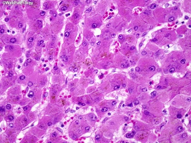 This histopathology image depicts a liver biopsy from a patient with chronic hepatitis B infection showing cirrhosis. The tissue is examined by brightfield light microscopy after Hematoxylin and Eosin staining. The parenchyma demonstrates nodular regeneration separated by dense fibrous septa, characteristic of cirrhotic remodeling. Hepatocytes within nodules are variably enlarged and display ground-glass cytoplasm, reflecting accumulation of hepatitis B surface antigen (HBsAg) within the cytoplasm. The cytoplasmic eosinophilia and moderate ballooning degeneration highlight chronic injury. Infiltrating inflammatory cells, predominantly lymphocytes and plasma cells, are present within portal tracts and fibrous bands, consistent with chronic inflammatory activity. Bile pigment accumulation may be observed in hepatocytes or canaliculi, contributing to intracellular pigment. The overall architectural disruption includes disrupted lobular arrangement and formation of regenerative nodules bordered by thick fibrous bands. The image is representative of HBV-related cirrhosis and emphasizes the histological hallmark features: ground-glass hepatocytes, fibrous septa, regenerative nodules, and hepatocellular inflammation. Clinically, these findings correlate with long-standing HBV replication, potential progression to portal hypertension, and increased risk of hepatocellular carcinoma; thus, this histology supports antiviral management decisions and HCC surveillance strategies, alongside serology and imaging assessments. This image is educational for hepatology and pathology training. Useful for diagnostics and differential diagnosis.