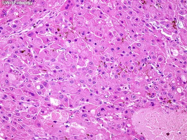 Histopathology: Light microscopy of a liver tumor with a solid growth pattern consistent with hepatocellular carcinoma (HCC). The specimen is a hepatic parenchymal tissue section stained with hematoxylin and eosin (H&E). Tumor cells form uniform, monomorphic sheets with evenly distributed nuclei, conspicuous nucleoli, and abundant eosinophilic cytoplasm. Bile production is prominent within tumor cells, and portal tracts are absent from the neoplasm, a feature typical of HCC. In this pattern, trabecular arrangements are compressed rather than endothelial cell-wrapped, requiring immunomarkers to highlight residual vascular architecture when necessary. The background liver shows preserved or cirrhotic changes depending on the sample. The differential diagnosis includes conventional trabecular HCC, fibrolamellar variant, and metastatic hepatobiliary tumors; however, the distinct solid sheets and lack of portal triads favor primary liver origin. Clinically, this histology supports a diagnosis of hepatocellular carcinoma, informs prognosis, and guides management, including surgical resection or locoregional therapies and systemic considerations. This image is suitable for pathology education, diagnostic correlation with imaging (CT/MRI), and research on HCC subtypes. Immunophenotype clues (if stained) include HepPar1 and glypican-3 positivity supporting hepatocellular origin; CD34 highlights sinusoidal capillarization in many HCCs; CK19 is typically negative or focally positive in certain variants; clinical correlation remains essential. Interpretation.