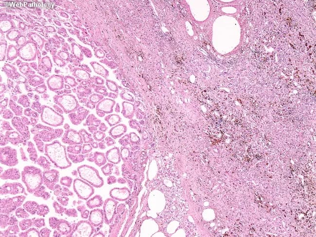 Imaging modality: Histopathology; Technique: Hematoxylin and Eosin (H&E) stained section with ancillary iron staining (Prussian blue) to identify hemosiderin. Specimen: Liver tissue, left hepatic lobe. The image demonstrates hepatocellular carcinoma (HCC) with a prominent acinar (pseudoglandular) growth pattern, forming gland-like spaces within malignant hepatocytes and separating from the adjacent native liver parenchyma. The tumor is well-demarcated from surrounding parenchyma, with a crisp interface and abrupt transition. The native liver shows marked hemosiderin deposition, consistent with long-standing hemochromatosis. Hemosiderin appears as brown granular pigment within hepatocytes and can be distinguished from bile by iron stains that yield positive results. The HCC cells are polygonal, with eosinophilic cytoplasm and variable nuclear atypia; architectural pattern includes acinar arrangements resembling glands rather than exclusively trabecular plates. Iron overload is clinically relevant as a widely recognized risk factor for hepatocarcinogenesis. Pathology findings support a diagnosis of iron-overload–associated hepatocellular carcinoma in a liver with iron deposition. Clinically, this morphology has implications for prognosis and therapeutic planning, including consideration of hepatic resection and post-operative surveillance. This image serves as a teaching resource illustrating iron overload, HCC histology, and the utility of iron staining in differentiating hemosiderin from bile.