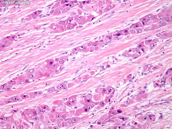 High-magnification light microscopy of a liver neoplasm stained with Hematoxylin and Eosin. The micrograph shows the fibrolamellar pattern, with thick, lamellar bands of dense, eosinophilic collagen (fibrous stroma) separating broad cords of neoplastic hepatocytes. The tumor cells are large and polygonal, with abundant granular eosinophilic cytoplasm and nuclei that are relatively large with prominent nucleoli. Cell borders are distinct and the architectural pattern resembles trabeculae separated by dense fibrous lamellae. The dense fibrosis produces a parallel, scirrhous-like appearance, contrasted with conventional HCC variants that lack diffuse parallel fibrosis. Immunophenotype is not provided in the image. This histology supports fibrolamellar hepatocellular carcinoma (FL-HCC), a hepatocellular carcinoma variant typically arising in noncirrhotic livers and younger patients, and distinguished from the scar-like scirrhous pattern of typical HCC by the combination of abundant cytoplasmic granularity and orderly fibrous bands. Diagnosis has prognostic and therapeutic relevance, as FL-HCC often exhibits distinct biology and prognosis compared with conventional HCC. This image is valuable for pathology education, morphologic differentiation, and search queries focused on FL-HCC, HCC scirrhous pattern, hepatocellular tumors with fibrous stroma, and high-detail liver histology. Correlate with clinical history, correlate with imaging findings, and consider immunohistochemistry if requested for confirmation.