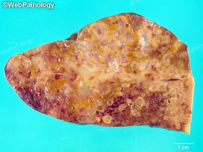 This gross liver specimen shows extensive metastatic disease with multifocal nodules disseminated through hepatic parenchyma. The cut surface is irregular and mottled tan-brown to yellow, with nodular, ill-defined expansions that replace normal liver tissue. A coarse surface irregularity and small, pale centers suggest focal necrosis within tumor deposits. The scale bar indicates 1 cm, providing size context for the nodules. The accompanying description notes metastasis from invasive ductal carcinoma of the breast in a patient status-post mastectomy and prior chemotherapy failure. In clinical practice, hepatic metastases are suspected on multiphasic CT or CT angiography, well demonstrated on dynamic contrast-enhanced MRI and FDG PET-CT, and are confirmed by image-guided needle biopsy or fine-needle aspiration. Obstructive jaundice is uncommon but may occur with bulky perihilar disease. Patients may be asymptomatic or present with weight loss, malaise, abdominal pain, or hepatic dysfunction. The gross appearance, combined with a history of breast cancer, supports a diagnosis of secondary liver involvement and carries a grave prognosis. Recognition of this pattern is essential for staging, treatment planning, and correlation with radiologic and histopathologic findings. This image exemplifies classic metastatic liver disease and reinforces the importance of integrating gross pathology with clinical history and imaging data collectively.