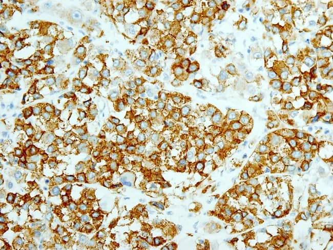 Immunohistochemistry on a formalin-fixed paraffin-embedded tumor section demonstrates strong, diffuse CD117 (c-KIT) positivity with DOG1 co-expression, consistent with a Gastrointestinal Stromal Tumor (GIST). The neoplasm shows rhabdoid features in a high-grade cellular morphology, including large polygonal tumor cells with eosinophilic cytoplasm, eccentrically placed nuclei, and conspicuous nucleoli set in a cutaneous-like solid or nested pattern and occasional spindle cells. The image, captured at high magnification with bright-field microscopy after DAB chromogen staining and hematoxylin counterstain, highlights membranous brown immunoreactivity in most tumor cells. Clinically, the background context describes a 60-year-old man with a perforated primary GIST of the cecum associated with a history of resistance to imatinib (Gleevec) and multiple metastases to liver, intercostal muscles, and diaphragm, indicating aggressive disease. The tumor’s aggressive behavior is supported by large size, necrosis, and a high mitotic index. Immunophenotype with CD117 and DOG1 positivity confirms GIST lineage and excludes many mimics (carcinoid, leiomyosarcoma, desmoid). This case underscores clonal evolution and possible secondary resistance to tyrosine kinase inhibition, with implications for therapy choices such as alternative TKIs (sunitinib, regorafenib) and consideration of surgical debulking if feasible. The finding has diagnostic and prognostic significance, guiding multidisciplinary management and genetic testing for KIT/PDGFRA mutations.