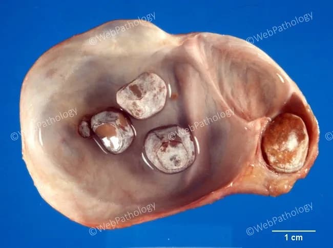 Gross pathology photograph of an opened gallbladder with cholelithiasis demonstrating hydrops due to cystic duct obstruction. The gallbladder is markedly distended with a thin, smooth lining of mucosa. An impacted calculus is seen at the cystic duct near the gallbladder neck on the right edge, with additional calculi within the lumen. Bile stasis and progressive dilation produce hydropic change without frank perforation. In adults, hydrops is most commonly caused by mechanical obstruction of the gallbladder neck or cystic duct by a stone; less commonly by tumor, fibrosis, cystic fibrosis-related thickening, ductal kinking, or external compression by a mass. In children, hydrops is typically acute, reversible, and often infectious; however, this image reflects an adult pattern of obstruction. The mucosa remains relatively smooth, and there is no overt acute cholecystitis shown. Pathophysiologic significance: obstruction leads to increased intraluminal pressure, bile stasis, mucosal atony, and potential secondary inflammation if persistent. Clinically, this pattern supports diagnosis of hydropic gallbladder due to gallstone disease and helps distinguish from inflammatory or neoplastic causes of gallbladder distension. Potential clinical use includes educational reference for surgical pathology, medical student training, radiologic-pathologic correlation, and differential diagnosis of biliary obstruction. Synonyms: gallbladder hydrops, hydropic gallbladder, obstructive cholecystopathy. Clinical relevance.