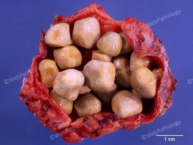 This is a macroscopic gross pathology photograph of a cholecystectomy specimen demonstrating cholelithiasis confined to the gallbladder. The lumen is densely packed with multiple cholesterol stones, disc-like to rounded, with smooth to slightly faceted surfaces and a pale yellow to tan coloration. Individual calculi measure approximately 0.5–1.5 cm in diameter, as inferred from the included 1 cm scale bar. The surrounding gallbladder wall is partially exposed with a red, friable serosa and mucosa not fully visible due to tissue handling. The stones appear radiolucent on plain radiographs in life; here they are visible only as macroscopic calculus clusters. The specimen illustrates classic features of cholesterol stones: low pigment, cholesterol-supersaturated bile and hypomotility contributing to stone formation. The image is optimized to highlight gross morphology suitable for educational and diagnostic reference in surgical pathology, hepatobiliary disease, and gastroenterology. Clinically, cholelithiasis is common in adults and may present with biliary colic or cholecystitis; cholesterol stones constitute the majority of gallstones. The image provides visual confirmation of stone burden within the gallbladder and can aid differential with pigment stones or mixed stones and in teaching radiology-pathology correlations. This image illustrates macroscopic appearance for teaching gross pathology and correlating with surgical pathology findings globally.