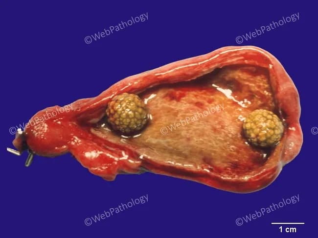 Gross pathology photograph of a cholecystectomy specimen demonstrating cholelithiasis with two cholesterol gallstones within the gallbladder lumen. The specimen is a distended gallbladder with a mucosal surface largely exposed and no obvious perforation. Two yellow-tan, faceted calculi, approximately 0.8-1.2 cm in diameter, are visible protruding into the lumen. The stones are cholesterol stones, common in symptomatic gallstone disease, formed from cholesterol supersaturation with bile and darkened by mucin adherence. The surrounding gallbladder wall shows mild serosal inflammation consistent with chronic cholecystitis rather than acute suppurative inflammation; no porcelain gallbladder is evident. The background tissue is red-brown, with clear gauze and ruler scale indicating 1 cm increments for size estimation. This gross image supports a clinical history of biliary colic and symptomatic cholelithiasis, typically precipitated by fatty meals and nocturnal gallbladder contraction. The image demonstrates classic features of cholesterol stones: pale yellow, radiolucent in typical composition, faceted surfaces, and dense aggregation at the gallbladder neck. Clinically, these findings corroborate preoperative diagnoses of biliary colic, cholecystitis, and cholelithiasis, and are relevant for educational purposes, surgical pathology correlation, and radiologic-pathologic correlation. Useful for teaching on gallbladder disease, stone morphology, and gross correlation with ultrasound findings. This image aids pathology teaching and examination objectively.