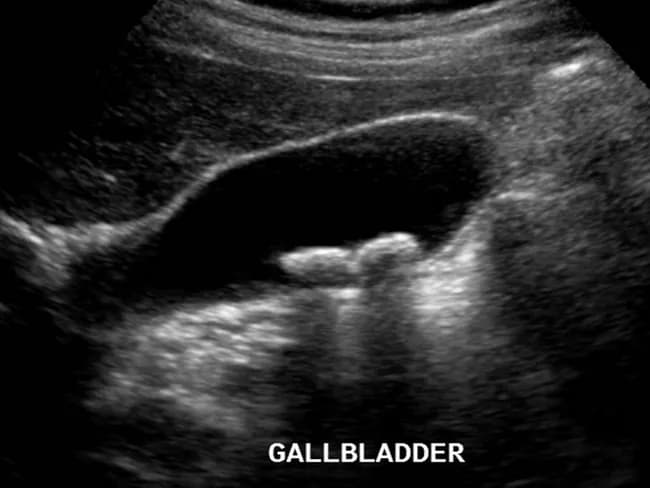 Ultrasound examination of the gallbladder using grayscale B-mode ultrasonography (transabdominal approach) demonstrates two echogenic foci within the gallbladder lumen. Both features are dependent on the gallbladder, implying intraluminal calculi rather than extrinsic objects. Each lesion casts a posterior acoustic shadow, a hallmark of gallstones, and their appearance distinguishes calcified cholesterol stones from gallbladder polyps, which typically lack shadowing. The stones measure over 2 millimeters in diameter, consistent with cholelithiasis and enabling reliable detection by ultrasound. The gallbladder wall appears without significant thickening, and there is no overt pericholecystic fluid evident on this image, arguing against acute cholecystitis at the time of imaging. The study highlights the classic sonographic criteria for gallstone disease: echogenic mobile calculi with clean shadowing, gravity-dependent location, and recognition of potential sludge in the gallbladder lumen. This imaging feature set supports clinical decisions regarding symptomatic biliary colic, risk stratification for complications, and surgical planning such as cholecystectomy. In differential considerations, gallbladder polyps or sludge can mimic stones; however, shadowing and mobility aid differentiation. Overall, ultrasound remains the initial modality of choice for suspected biliary pathology due to safety, accessibility, and high diagnostic yield. Correlative clinical data and laboratory tests further refine management decisions. Guiding patient-specific treatment options.