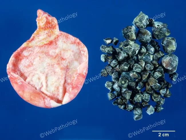 This gross pathology photograph documents massive cholelithiasis with densely packed pigment stones within the gallbladder. The left panel shows a partially opened gallbladder specimen with a pale mucosal surface and residual bile, while the right cluster consists of numerous dark stones laid out for visualization. The stones are black to dark green in color, with a mulberry-like, irregular morphology and spiculated or molded contours. They are small in size, typically 0.2–0.5 cm, but a minority can reach larger dimensions; in this case, a very heavy burden is present with approximately 130 stones. The stones are hard and resistant to crushing, contrasting with brown pigment or cholesterol stones which are usually softer. The overall appearance is characteristic of black pigment gallstones (calcium bilirubinate) formed in the setting of chronic biliary infection or hemolysis. This stone type is often radiopaque and may be associated with pigment deposition in the gallbladder mucosa and chronic cholecystitis. Clinically, pigment stones accompany biliary stasis and inflammatory changes and increase risk for gallstone-related complications such as biliary colic, cholecystitis, or pancreatitis. This specimen provides a valuable teaching example for stone morphology, composition, and differential diagnosis between pigment and cholesterol stones, and illustrates the extreme stone burden possible in pigment stone disease.