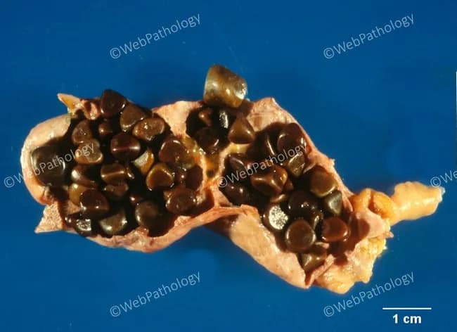 Gross pathology photograph of a gallbladder specimen with cholelithiasis. Modality and technique: Macroscopic imaging of an excised gallbladder, with its lumen largely filled by numerous dark, hard stones. The stones are black to dark brown, variably sized from a few millimeters up to about one centimeter, with smooth to slightly faceted surfaces. The surrounding gallbladder wall appears tan-pink with focal mucosal distortion, consistent with chronic inflammation. The image demonstrates classic features of black pigment gallstones formed primarily from calcium bilirubinate in settings of chronic hemolysis, where accelerated bilirubin turnover promotes pigment precipitation. Surface characteristics are variable; some stones are glossy, others dull. The specimen is presented in longitudinal section showing stones occupying the lumen and adherent to mucosa. The composition is expected to be calcium bilirubinate-enriched pigment; cholesterol is minimal. Radiodensity on gross imaging is not appreciable. Clinically, pigment stones in hemolytic disease are associated with increased bilirubin load, risk of biliary colic, cholecystitis, and possible bile duct obstruction from stone migration. This image supports medical education, pathology training, differential diagnosis of cholelithiasis etiologies, and radiology correlation in hepatobiliary disease, including hemolysis-related pigment stone formation and surgical pathology reporting for teaching.