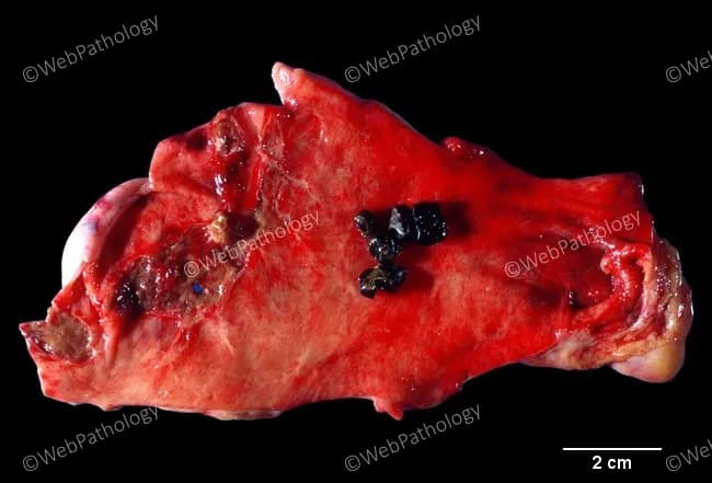 Gross pathology photograph of a gallbladder specimen showing thickened wall with Rokitansky-Aschoff sinuses and mucosal ulceration. Several small black pigment gallstones are embedded within the ulcerated mucosa near the left edge of the tissue. The stones appear faceted with a dense, glossy surface and are surrounded by inflamed, reddened mucosa. Rokitansky-Aschoff sinuses are mucosal outpouchings extending into the muscularis propria, reflecting chronic inflammatory remodeling typical of chronic cholecystitis. The embedded stones indicate mucosal erosion rather than intraluminal lodging. The cut surface reveals fibrous, contracted gallbladder wall with focal firmness and pearling along the serosa. A clear 2 cm scale bar is visible on the image. The overall specimen demonstrates features consistent with long-standing cholelithiasis with secondary inflammation. Pigment stones, often composed of calcium bilirubinate, are associated with hemolysis, infection, biliary stasis, or biliary infections. Clinically, these findings support gallbladder removal (cholecystectomy) and correlate with pain, biliary colic, and potential chronic cholecystitis. Differential considerations include chronic cholecystitis with cholelithiasis; less likely are gallbladder neoplasms arising in chronic inflammatory settings. Histologic confirmation would assess mucosal and muscularis changes and exclude carcinoma. Documentation of orientation, margins, and ancillary testing would enhance diagnostic precision and guide postoperative surveillance planning for at-risk patients and outcomes.