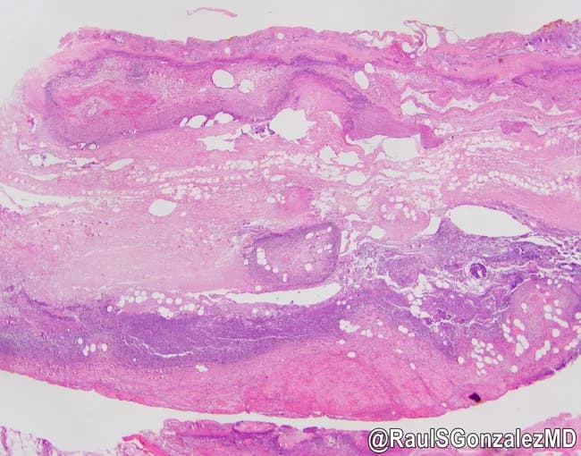 This image depicts a histopathologic section of the gallbladder wall stained with Hematoxylin and Eosin, viewed under brightfield light microscopy at low to moderate magnification. The specimen demonstrates acute emphysematous cholecystitis characterized by transmural inflammation with necrosis of the gallbladder wall. The mucosa is disrupted, and the muscularis shows dense neutrophilic infiltration and edema. Notably, numerous gas-filled spaces occupy the gallbladder wall and subserosal regions, producing empty-appearing lacunae that reflect intramural gas bubbles produced by gas-forming organisms. The surrounding tissue exhibits acute inflammatory exudate and focal necrosis, with hemorrhagic/serosanguinous components in the serosal surface. These features distinguish emphysematous cholecystitis from simple acute calculous cholecystitis and indicate a more fulminant infectious process. Clinically, this pathology corresponds to a high-risk surgical emergency with potential rapid progression to perforation and peritonitis if not promptly treated. Correlates with diabetes mellitus risk, elderly male patients, and poor tissue perfusion. The image is provided courtesy of Dr. Raul Gonzalez, with permission. Overall, the slide highlights the destructive inflammatory response, gas production within the gallbladder wall, and the necessity for urgent diagnosis and management in suspected cases of emphysematous cholecystitis. This histology correlates with radiologic gas patterns and supports urgent cholecystectomy planning in rapidly progressive cases.