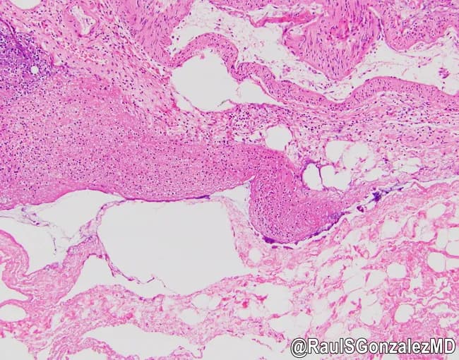 Histology of gallbladder wall illustrating acute emphysematous cholecystitis. The specimen is examined as a cross-sectional histologic slide prepared with Hematoxylin and Eosin stain and observed under light microscopy. The gallbladder wall shows transmural acute inflammation with dense neutrophilic infiltrate, mucosal ulceration, edema, and necrosis extending through the mucosa, muscularis, and serosa. Notably, intramural gas pockets create empty spaces within the wall, producing emphysematous changes. The overall architecture is disrupted by necrosis and inflammatory edema; vascular congestion and focal hemorrhage may be present. The image demonstrates gas-forming phenomenon within the gallbladder wall consistent with emphysematous cholecystitis, a surgical emergency with risk of gallbladder perforation, peritonitis, and sepsis. Clinically, this entity is associated with diabetic or elderly patients and correlates with rapid progression and high mortality if untreated. The histopathology complements radiologic findings of gas within the gallbladder and pericholecystic tissues. The data is relevant for education, pathology teaching, differential diagnosis between emphysematous and gangrenous cholecystitis, and research on gas-forming infections of the biliary tract. This representation aids learners in recognizing the hallmark correlate between microscopic gas spaces and tissue necrosis, guiding prompt surgical consultation, antibiotic therapy, and postoperative care. It also supports comparative studies of biliary tract infections in diabetic populations.