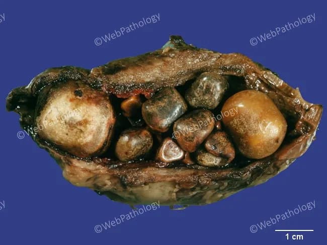 Gross pathology photograph of an opened gallbladder demonstrating chronic calculous cholecystitis with marked cholelithiasis. The lumen is densely filled by numerous mixed cholesterol stones of variable size, ranging from tiny calculi to several millimeters in diameter. Stones exhibit tan to brown coloration with smooth to slightly faceted surfaces, consistent with cholesterol-rich, mixed biliary calculi. The gallbladder wall is focally thickened and fibrotic, reflecting chronic inflammatory change; subtle mucosal irregularities may be present, but no focal ulceration is evident in this view. The specimen is positioned against a color-calibrated background with a 1 cm scale bar for size reference. This gross appearance correlates with long-standing gallstone disease and chronic inflammation, rather than acute cholecystitis. Diagnostic significance lies in confirming cholelithiasis with chronic cholecystitis, guiding surgical pathology submission and influencing prognosis. Clinically, this pattern is associated with episodic biliary colic, risk of cholangitis if obstruction occurs, and potential progression to gallbladder fibrosis or porcelain gallbladder in advanced cases. Differential considerations on gross exam include calcified or pigment stones, but the predominance of cholesterol stones with wall thickening supports chronic calculous cholecystitis. This image serves as an educational reference for gross anatomy, surgical pathology, and hepatobiliary disease assessment, and complements histologic evaluation by providing macroscopic context for stone burden and wall remodeling.