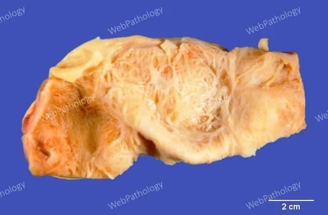 Gross pathology photograph of an excised gallbladder illustrating chronic calculous cholecystitis with gallstone obstruction. Ex vivo specimen photographed with scale; the wall shows marked hypertrophy of the muscularis propria and fibrous thickening consistent with long-standing inflammation. The mucosa is relatively inconspicuous beneath the thickened muscular layer. Gallstones are present within the lumen, contributing to increased intraluminal pressure and episodic biliary stasis. The external surface may appear pale to tan with irregular contour owing to fibrotic remodeling. This image highlights the pathophysiology of chronic obstruction: progressive mural hypertrophy, submucosal fibrosis, and potential porcelain gallbladder phenotype if calcification is extensive. The specimen represents biliary tract disease related to cholelithiasis and chronic cholecystitis, clarifying how stone burden correlates with wall remodeling observed in radiologic and gross examinations. Clinically this finding correlates with long-standing biliary colic, right upper quadrant discomfort, and risk of gallbladder complications such as empyema or carcinoma in chronic disease. This photograph is educational for pathology training, surgical planning, and radiology-pathology correlation. Suitable for teaching gross anatomy, disease progression, and specimen processing workflow, including fixation, sectioning, and paraffin embedding for subsequent histology. The scale bar (2 cm) in the image provides quantitative context for wall thickness and lumen caliber assessment precisely.