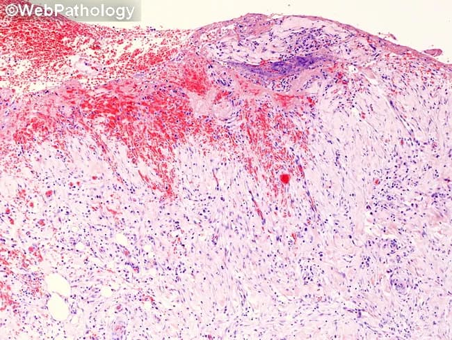 This histopathology image depicts gallbladder wall tissue from chronic calculous cholecystitis evaluated by light microscopy after Hematoxylin and Eosin (H&E) staining. The mucosal lining shows variability in integrity with focal atrophy and scarring, while the underlying layers display transmural chronic inflammation involving the mucosa, muscularis propria, and extending toward the serosa. The inflammatory infiltrate is dominated by lymphocytes and plasma cells, with macrophages and rare neutrophils, consistent with a long-standing inflammatory process. Fibrosis and architectural distortion of the gallbladder wall are evident, reflecting chronic injury and healing. The serosal surface demonstrates hemorrhagic exudate, indicating serositis and superimposed vascular leakage. Although gallstones are classically associated with chronic cholecystitis, this histological field focuses on wall pathology and may not clearly display calculi. These features help distinguish chronic cholecystitis from acute inflammatory changes, which would show predominant neutrophilic infiltration and edema, and from cholesterolosis or adenomyomatosis, which feature mucosal lipid-laden macrophages or mucosal gland proliferation, respectively. Clinically, such histology correlates with chronic biliary pain, prior gallstone disease, cholecystitis risk for gallbladder dysfunction, and potential complications such as cholestasis or gallbladder empyema if untreated. This image is valuable for pathology education, differential diagnosis practice, and radiologic–pathologic correlation in hepatobiliary diseases.