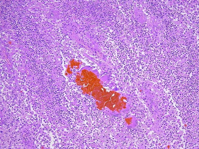 Imaging modality: bright-field light microscopy of a hematoxylin and eosin–stained gallbladder wall section, illustrating xanthogranulomatous inflammation. Anatomy: gallbladder wall with mucosa, submucosa, muscularis, and Rokitansky-Aschoff sinuses. Visual features: dense inflammatory infiltrate composed of lipid-laden foamy macrophages (xanthomatous histiocytes), plasma cells, lymphocytes, scattered neutrophils, and multinucleated giant cells; cholesterol clefts and bile pigments embedded within fibrotic stroma; focal ulceration and scattered calcifications are possible; perivascular and interstitial distribution with intralesional granulomas. Pathology: xanthogranulomatous cholecystitis (XC) characterized by foam cells, cholesterol crystallization, cholesterol clefts, foreign-body-type granulomas, and bile extravasation into subepithelial mesenchyme that provokes a vigorous inflammatory response; secondary bacterial superinfection may contribute. Diagnostic significance: essential to differentiate XC from gallbladder neoplasia; recognition prevents misdiagnosis of carcinoma and guides surgical management; histology may reflect chronic biliary obstruction and pigment deposition. Differential considerations: chronic cholecystitis without XC; cholesterolosis; adenomyomatosis; gallbladder adenocarcinoma or other gallbladder neoplasms with desmoplasia; infectious cholecystitis. Clinical correlation: commonly accompanies gallstones and chronic biliary disease; post-surgical histology confirms diagnosis and influences prognosis, follow-up, and patient counseling. Potential educational uses: pathology atlas references, diagnostic pattern recognition, and research into inflammatory gallbladder diseases. This image exemplifies XC histology for teaching, reference libraries, and computational indexing.
