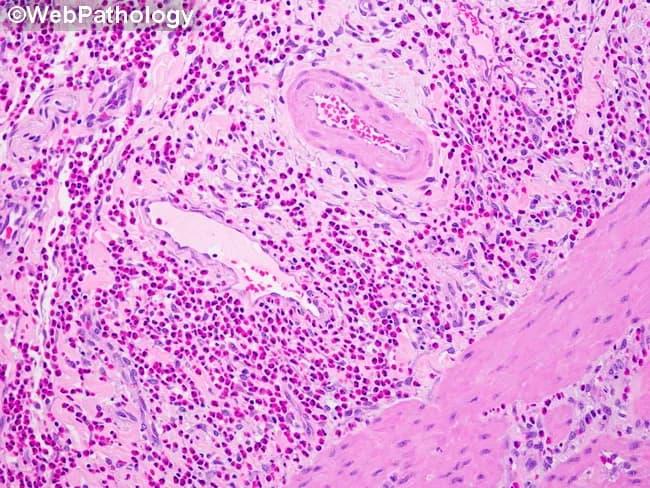 Histopathology; Hematoxylin and Eosin stained gallbladder tissue demonstrating pure eosinophilic infiltrate within the lamina propria. The mucosal architecture is preserved without stromal necrosis or significant neutrophilic infiltration. Eosinophils appear as round to irregular cells with bilobed or multilobed nuclei and abundant bright pink-orange cytoplasmic granules, forming dense networks in the lamina propria surrounding ductal structures and capillaries. The submucosa is largely unremarkable, and no mural granulomas or ulceration are evident. Vascular congestion may be present secondary to inflammatory edema. Scattered lymphocytes and plasma cells are minimal, with eosinophils constituting the predominant inflammatory cell type. A scattered macrophage population is observed adjacent to small vessels. No gallstones are visible in this field, and there is no evidence of acute neutrophilic cholangitis. This pattern is characteristic of eosinophilic cholecystitis, a rare inflammatory variant often linked to allergic or parasitic processes, drug reactions, or hypereosinophilic syndrome. Clinically, eosinophilic cholecystitis may present with right upper quadrant pain and cholecystitis-like symptoms, but peripheral eosinophilia or serologic allergy markers may be absent. The diagnostic significance lies in recognizing eosinophil-predominant inflammation, guiding differential diagnosis, investigative workup for eosinophilia, and management focusing on underlying triggers and symptomatic gallbladder relief.