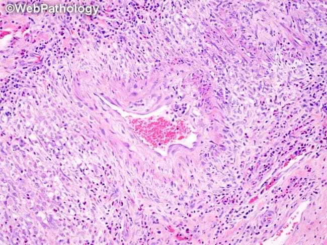 Histopathology of gallbladder tissue reveals necrotizing transmural vasculitis of medium-sized muscular arteries within the gallbladder wall. The vessel wall exhibits fibrinoid necrosis and inflammatory infiltrates that are initially neutrophilic and eosinophilic, with histiocytes; the surrounding tissue typically shows minimal inflammatory reaction. Lesions are discontinuous, with skip areas, and multiple vessels commonly display varying stages of evolution within a single specimen. In active lesions, transmural inflammation encroaches on all vascular layers, culminating in destruction of the tunica media and internal elastic lamina; elastic stains most clearly demonstrate lamina destruction. In healed or healing stages, fibrointimal proliferation produces luminal narrowing or occlusion. The inflammatory infiltrate may transition to a lymphocytic predominance during resolution. Importantly, bystander inflammation related to adjacent cholecystitis must be distinguished from true vasculitis. The grossly preserved surrounding gallbladder parenchyma contrasts with the targeted vascular injury. These features are characteristic of polyarteritis nodosa and may reflect systemic vasculitis when observed in the gallbladder, prompting clinical correlation for systemic symptoms and laboratory markers (ANCA status is often negative in classic PAN). This histology underlines the need for immunosuppressive therapy and vigilance for renal, gastrointestinal, and vascular complications. Correlation with clinical data guides targeted treatment and prognosis assessment in systemic vasculitis workup.