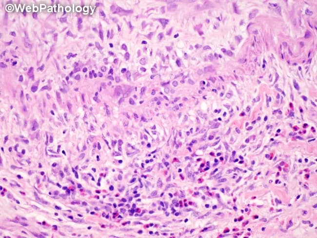 This histopathology image depicts a gallbladder wall section showing classic necrotizing vasculitis of medium-sized muscular arteries consistent with polyarteritis nodosa (PAN). The salient feature is transmural inflammation of the vessel wall with fibrinoid necrosis and disruption of the tunica media and internal elastic lamina, best seen with elastic stains but evident on routine H&E as pale, eosinophilic necrosis surrounding a dense inflammatory infiltrate. In active lesions, the infiltrate comprises neutrophils and eosinophils admixed with histiocytes; skip areas indicate discontinuous involvement with uninvolved interposed segments. The inflammatory process may spare adjacent gallbladder parenchyma, defining a bystander phenomenon rather than true parenchymal inflammation. In healing stages, the vessel shows fibrointimal proliferation and progressive luminal narrowing, reflecting irreversible remodeling. The image underscores the need to distinguish true necrotizing vasculitis from secondary vascular inflammation seen with acute or chronic cholecystitis. Clinically, PAN-related gallbladder involvement signals a systemic vasculitis that may accompany renal and gastrointestinal manifestations; diagnosis rests on histology, correlation with serology (often ANCA-negative in classic PAN), and integration with radiographic or clinical vasculitis features. This specimen exemplifies how vascular lesions can be segmental and heterogenous within a single gallbladder biopsy, influencing prognosis and therapeutic planning (steroids, immunosuppressants). Guiding patient management decisions.