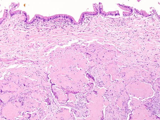 Comprehensive Description: This is a histopathology slide of a cutaneous skin biopsy examined with bright-field microscopy after hematoxylin and eosin staining. The specimen shows a perpendicular transection through epidermis, dermis, and subcutaneous fat. The epidermis exhibits marked acanthosis with elongation of rete ridges and mild hyperkeratosis, while the basal layer remains intact. The dermis contains variably dense fibrous stroma with sparse chronic inflammatory cells. Beneath the dermis, the subcutaneous tissue is dominated by mature adipocytes arranged in lobules separated by thin fibrous septa. No cytologic atypia, mitotic figures, or infiltrative tumor margins are evident. The overall architecture favors a benign adipose-rich process, such as a lipomatous lesion, with epidermal remodeling that may accompany adjacent subcutaneous fat expansion. There is no clear evidence of malignancy, inflammatory panniculitis, or granulomatous reaction in the field shown. Staining quality permits clear visualization of adipocytes (large clear cytoplasm), connective tissue septa, and epidermal layers. This image is useful for dermatopathology teaching, correlating histologic patterns of lipomatous subcutaneous lesions with overlying epidermal changes, and supporting differential diagnosis including lipoma, fibrolipoma, and, less likely, liposarcoma in cutaneous/subcutaneous tissue. It provides a reference for pattern recognition and morphology in skin biopsy evaluation. Clinically relevant across education and research.