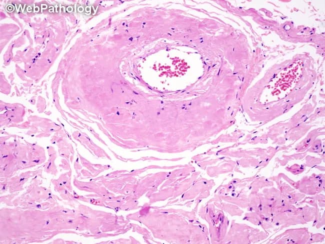 Comprehensive Description: This is a light microscopy histopathology image of a small artery/arteriole in hematoxylin and eosin (H&E) stained tissue, captured at a transverse cross-section. The vascular wall shows pronounced onion-skin hyperplasia with concentric, laminated intimal and medial cell layering, leading to marked luminal narrowing. The wall is thickened by smooth muscle cell proliferation and basement membrane reduplication, producing alternating dense and pale bands around the lumen. The surrounding parenchyma reveals fibrous connective tissue and sparse inflammatory cells; endothelial cell details are not distinct at this magnification. The appearance is characteristic of hyperplastic arteriolosclerosis, classically associated with malignant hypertension or accelerated hypertension. In contrast to hyaline arteriolosclerosis, which produces homogeneous eosinophilic thickening, the onion-skin pattern reflects proliferative remodeling of the vessel wall. Notable features may include mild perivascular fibrosis and variable luminal caliber, with potential ischemic susceptibility in involved territories. Clinically, this finding supports a hypertensive emergency in context with acute end-organ injury (kidney, brain, retina) and guides aggressive blood pressure management. Differential considerations include polyarteritis nodosa and other vasculitides when necrotizing inflammation is present; however, this image lacks transmural fibrinoid necrosis and significant inflammatory infiltrate. This slide is educational for pathology, histology teaching, and radiology-pathology correlation. Practice today together.