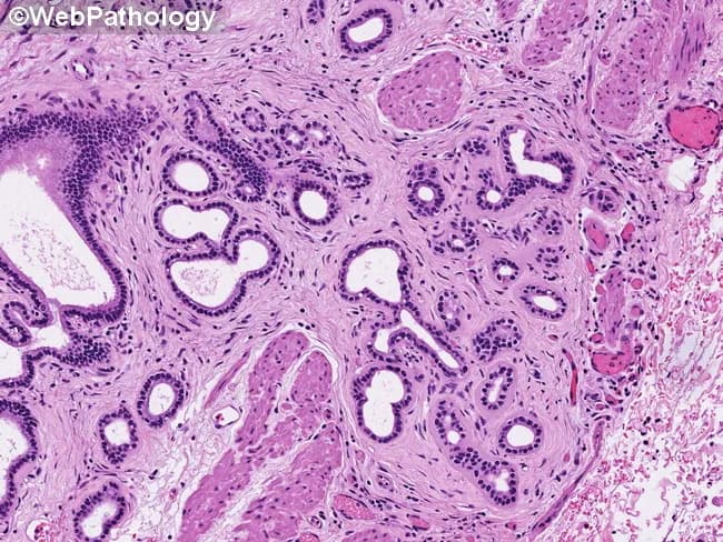 Brightfield hematoxylin and eosin (H&E) stained histology of the gallbladder neck and cystic duct region. Peribiliary mucous glands form a characteristic lobular architecture with evenly spaced, uniform tubules embedded in the fibromuscular lamina propria. The glands are lined by cuboidal to low-columnar mucinous epithelium with minimal cytologic atypia, mild cytoplasm, and rare mitotic figures. The glands lie in close proximity to the biliary epithelium but remain within the peribiliary/submucosal compartment, without evidence of stromal invasion or desmoplastic reaction. This benign pattern can be mistaken for invasive adenocarcinoma if the glands are sampled in a disorganized fashion or show crowding near the gallbladder neck. In contrast, invasive carcinoma glands are typically haphazardly scattered, infiltrative, and accompanied by cytologic atypia, desmoplasia, and irregular nuclear features. The image highlights orderly glandular lobules, uniform tubules, and lack of cytologic atypia, supporting a benign peribiliary gland process. Clinically, recognizing this pattern is essential to avoid overtreatment, especially in limited biopsy samples. Correlation with gross anatomy and imaging, and, when needed, ancillary stains or immunohistochemistry can help distinguish benign peribiliary gland hyperplasia from biliary adenocarcinoma. This distinction influences prognosis and therapeutic planning. Appropriate sampling and awareness reduce false positives in needle biopsies and guide management decisions.