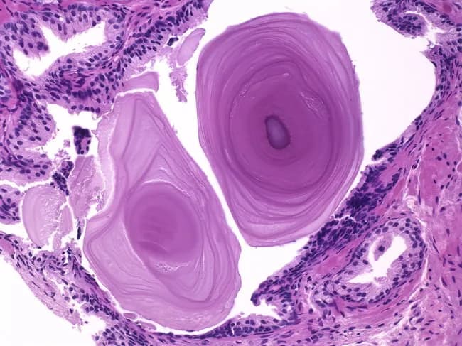 Imaging modality: Light microscopy of Hematoxylin and Eosin stained prostatic tissue section from a biopsy or surgical specimen. The slide shows corpora amylacea: round to oval, lamellated, laminated bodies within the luminal spaces of prostatic glands. These acellular, eosinophilic concentric rings encircle a central core. They vary in size and color, appearing pink to purple to golden brown depending on staining and illumination. Originates from layers of inspissated secretions deposited around shed acinar epithelial cells. In the surrounding stroma, prostatic glands show benign features with intact architecture; no infiltration or atypia is observed. The corpora amylacea are typically incidental and benign; they may be seen in aging prostates and with chronic prostatitis; their presence does not imply malignancy. Histologically, corpora amylacea can form within lumens of acini and ducts, representing late secretory products that calcify over time. The diagnostic significance is mainly incidental; the differential includes calcifications and other laminated concretions; correlation with clinical context and age is recommended. This image is relevant for teaching prostatic histology, aging changes, benign prostatic pathology, and differentiation from neoplastic processes in the prostate. Potential clinical uses include educational case discussions, pathology lab QA, and reference for identifying corpora amylacea in prostatic biopsies.
