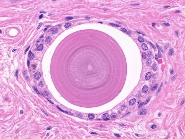 This brightfield light microscopy image presents a histologic cross-section through prostatic glandular tissue, highlighting a prominent corpora amylacea in the central acinar lumen. The central portion exhibits radiating, laminated rims that extend outward, producing concentric bands with a bull’s-eye appearance. Surrounding the laminated core are circular to oval prostatic acini lined by benign cuboidal epithelium and supported by fibromuscular stroma. The corpora amylacea are eosinophilic and often PAS-positive; they may undergo calcification to form gritty calculi that can be palpated in radical prostatectomy specimens. The adjacent stroma and epithelial components show no nuclear atypia, mitotic activity, or infiltrative growth, consistent with benign prostatic glands. This structure is not a neoplasm; corpora amylacea are age-related and occur more commonly in benign glands than in carcinoma, though their presence can occasionally complicate interpretation of small foci of atypia. Morphologically, the laminated bodies illustrate chronic, degenerative changes and may serve as incidental histologic markers of aging prostate tissue. Clinically, recognizing corpora amylacea helps avoid misdiagnosing benign calcified bodies as malignant processes and supports age-appropriate differential diagnoses in radical prostatectomy evaluation. Correlation with patient history, PSA values, and imaging findings can further refine the clinical interpretation and minimize unnecessary treatment in routine practice today.
