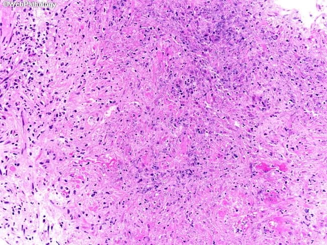 This is a high-magnification histopathology image of prostatic tissue examined by light microscopy after hematoxylin and eosin staining. The specimen is a core biopsy obtained from the prostate gland in a patient with known granulomatosis with polyangiitis (Wegener) and recent pulmonary involvement. The tissue shows necrotizing granulomatous inflammation characterized by aggregates of epithelioid histiocytes and multinucleated giant cells surrounding central areas of eosinophilic or caseous-like necrosis. A dense inflammatory infiltrate, including neutrophils and lymphocytes, permeates the stroma and disrupts normal prostatic architecture, with partial preservation of acini in some regions. Small- to medium-sized vessel involvement compatible with vasculitis can be identified within the inflammatory infiltrate. The palisading arrangement of histiocytes and necrotic foci are hallmark features. No definite malignancy is evident in the sampled cores. The appearance is typical for prostatic GPA involvement, although infectious etiologies or sarcoidosis may mimic granulomatous prostatitis; correlation with microbiologic studies and serology is advised. Clinically, prostatic GPA, though uncommon (estimates 2.5–7.5%), carries significance for disease activity assessment and therapeutic decision making, as immunosuppressive regimens are tailored to systemic vasculitis burden. This image supports multidisciplinary evaluation of genitourinary involvement in GPA. The image is a teaching reference for recognizing GPA-associated granulomatous prostatitis on prostatic biopsy and to illustrate the importance of correlating clinical history with histology.