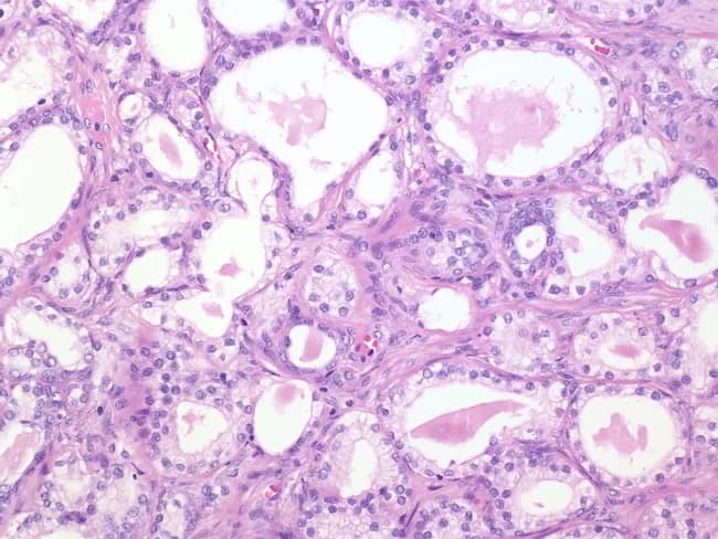High magnification hematoxylin and eosin stained sections from a transurethral resection specimen show benign prostatic tissue with atypical adenomatous hyperplasia (adenosis). Glandular units vary in size and display round, oval, or irregular lumina. The epithelial cytoplasm is pale, contrasting with the amphophilic cytoplasm commonly seen in prostatic adenocarcinoma. Nuclei are not markedly enlarged and prominent nucleoli are generally absent; however, in up to about 30% of cases nucleoli may be conspicuous. The architecture consists of densely packed acini forming small, tight clusters without destructive invasion or stromal desmoplasia. Basal cell layering, when preserved, supports a benign process, and cytologic atypia is mild relative to carcinoma. The lesion overlaps with features that can mimic cancer, so careful assessment of invasion, nucleolar prominence, mitotic activity, and glandular polarity is essential. This image highlights a benign proliferative process, benign mimics of neoplasia, and the importance of correlating histology with clinical data. Clinically, distinguishing adenosis from prostatic adenocarcinoma influences management, PSA interpretation, and surveillance strategy. The findings are relevant for surgical pathology education, differential diagnosis discussions, and educational case repositories aiming to illustrate pitfalls in prostate lesion interpretation, particularly in TURP specimens. Educational value. Educational context for pathology residents and practicing clinicians worldwide today.