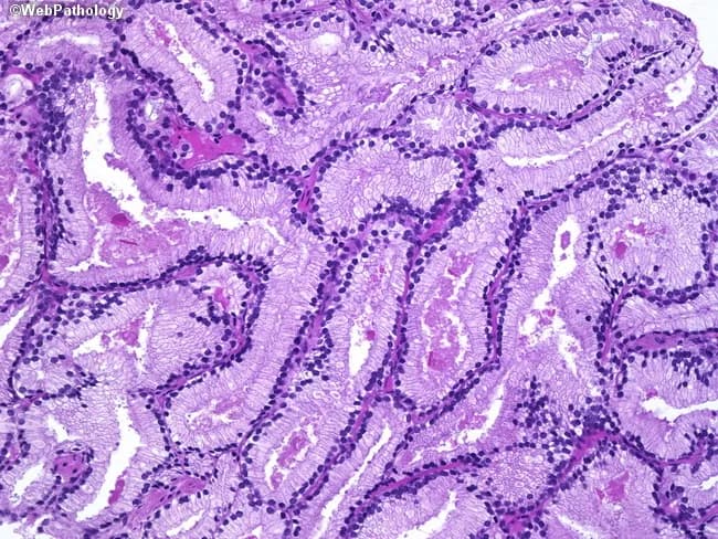 High-power histology image of prostatic acinar adenocarcinoma (Gleason score 3+3=6) viewed under bright-field light microscopy. The specimen demonstrates well-formed, back-to-back glands infiltrating the periglandular stroma, consistent with low-grade malignant acinar architecture. Gland lumina are generally round to slightly elongated, lined by a single layer of cuboidal to columnar epithelial cells with mild cytologic atypia, small central nuclei, and occasional stratification. The basal cell layer characteristic of benign prostatic acini is not evident within the malignant glands, and there is minimal desmoplastic reaction. The glands vary in size but maintain a predominantly tubular, well-differentiated appearance without prominent cribriform, fused, or solid growth patterns, which aligns with Gleason pattern 3. Nuclei show modest enlargement; nucleoli are rarely conspicuous in this field. Overall morphology supports a low-grade prostatic adenocarcinoma, with infiltration into surrounding stroma but without high-grade features locally evident. This image captures a classic example applicable to educational discussions of prostate cancer grading, prognosis, and management implications. Clinically relevant keywords include prostate cancer, acinar adenocarcinoma, Gleason 3+3, tumor architecture, well-formed glands, low grade, and active surveillance considerations. It complements histology teaching of tumor grading systems and is suitable for radiologic-pathologic correlation and pathology review.