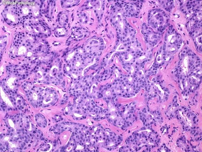 High-magnification histopathology image of a prostate needle core biopsy stained with Hematoxylin and Eosin. The sample demonstrates prostatic adenocarcinoma with cribriform architectural pattern (Gleason pattern 4) forming anastomosing clusters and ill-defined, punched-out lumina within an infiltrative stroma. The glands are irregular, tightly packed, and display cytologic atypia characterized by increased nuclear size, hyperchromasia, and prominent nucleoli. This high-grade neoplasm shows minimal intervening benign prostatic acini, with a cribriform network extending variably, consistent with Gleason score 4+4=8. The abundant malignant glands exhibit solid and cribriform growth rather than broad, well-differentiated acini, indicating aggressive histology. No definitive perineural invasion is identifiable in this field, though occasional invasion of surrounding stroma may be present in other sections. The image highlights diagnostic features used for grading: architectural disarray, cribriform glands with punched lumina, and conspicuous cellular atypia, supporting a high-grade prostate cancer diagnosis. Clinically, this pattern portends intermediate to high risk, guides treatment planning towards definitive local therapy with adjuvant systemic approaches, and necessitates correlation with serum PSA values, MRI staging, and potential molecular studies. Recognizing this cribriform pattern is essential for pathologists and clinicians as it influences prognosis, aggressiveness, and management decisions. This image serves as an educational reference for education, diagnosis, and research.