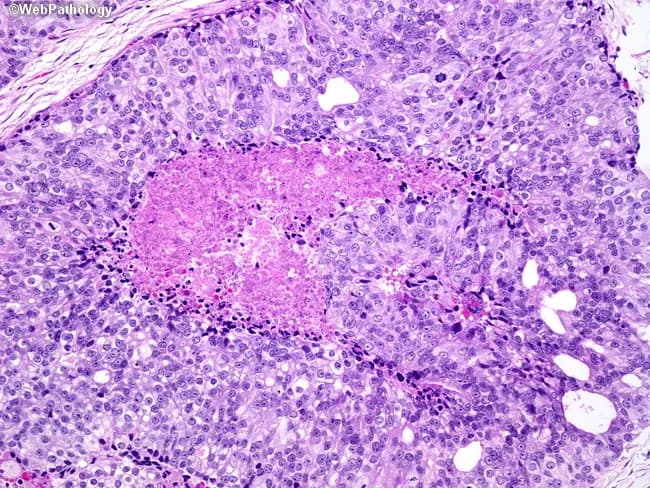Histopathology: Prostate tissue examined by light microscopy after Hematoxylin and Eosin staining reveals high-grade prostatic adenocarcinoma with solid nests exhibiting comedonecrosis. The center shows necrotic ghost remnants surrounded by a layer of karyorrhectic debris; at the periphery, layers of viable malignant epithelial cells display enlarged, hyperchromatic nuclei and prominent nucleoli. The architectural pattern includes solid and cribriform nests with occasional back-to-back glands, consistent with Gleason pattern 5. Overall Gleason score is 10 (5+5). Notable features include extensive tumor necrosis, conspicuous cytologic atypia, and a high nuclear-to-cytoplasmic ratio. Tumor invasion of the adjacent stroma is evident in places, with limited mitotic activity but aggressive phenotype suggested by necrotic cores and dense cellularity. Clinically, this histology indicates a highly aggressive, poorly differentiated lesion with elevated metastatic potential and poorer prognosis compared with lower Gleason scores. This finding supports definitive management with multimodal therapy and close staging. For educational and diagnostic use, this image demonstrates comedonecrosis in prostatic adenocarcinoma, cribriform/high-grade patterns, and the cytologic features that contribute to Gleason grading and prognostic assessment.
