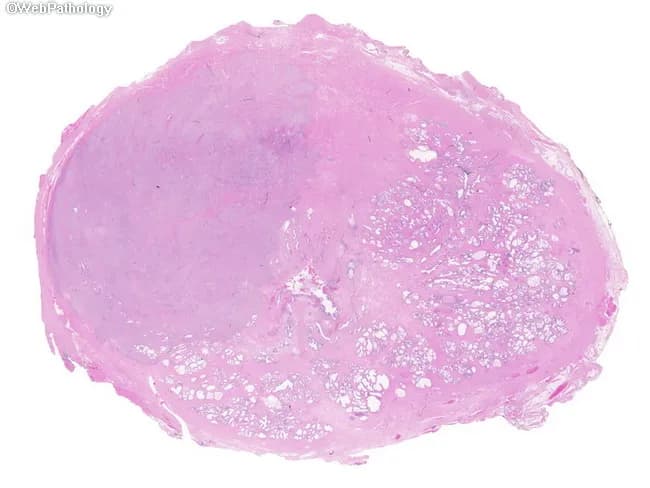 Prostate gland histopathology slide, whole-mount preparation, hematoxylin and eosin (H&E) stained. The primary subject is prostatic adenocarcinoma with a dominant left-sided nodule, in which the normal prostatic architecture is completely effaced by tumor tissue. The right hemiprostate shows relatively preserved benign acini, highlighting focal contrast between malignant and benign glands. The lesion displays infiltrative, irregular glandular structures with neoplastic epithelial cells, showing cytologic atypia and nuclear enlargement in a cribriform to poorly formed gland pattern. The tumor nests invade the stroma and disrupt normal glandular contours, with loss of basal cell layer typical of invasive carcinoma; perineural invasion may be present but not definitively demonstrable at this low magnification. Overall, this image illustrates classic focal prostatic adenocarcinoma within a radical prostatectomy whole-mount, emphasizing potential multifocal disease while presenting a single dominant nodule. The left-sided dominance underscores intra-glandular heterogeneity common in prostate cancer. This histology snapshot is relevant for Gleason grading, risk stratification, and surgical planning, as well as for educational discussion of tumor biology, clonal variation, and the pitfall of conflating malignant foci with benign hyperplasia in limited sampling. Clinically, such patterns influence prognosis and management, including potential focal therapy versus radical intervention.