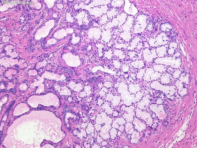 This histopathology image shows prostate tissue with mucinous differentiation within a benign prostatic hyperplasia (BPH) nodule. Prepared as a formalin-fixed, paraffin-embedded section and visualized by brightfield light microscopy, the slide is stained with Hematoxylin and Eosin (H&E). The right half of the field demonstrates extensive mucinous metaplasia in which the normal glandular epithelium is replaced by mucin-secreting cells. The involved glands appear lighter pink due to abundant mucin within the lumen and cytoplasm, producing a pale, glassy appearance compared with adjacent non-mucinous glands. Glandular architecture remains benign without overt invasion or high-grade cytologic atypia. The mucin pools are intra- and peri-luminal, sometimes compressing surrounding stroma but preserving overall prostatic acinar arrangement. This entity is considered an incidental, benign variant, with no malignant potential, and must be distinguished from mucinous (colloid) adenocarcinoma, which would demonstrate infiltrative growth and mucin lakes with malignant epithelial cells. The image highlights a spectrum of prostatic mucinous differentiation, emphasizing that mucinous metaplasia can occur within BPH nodules and often lacks clinical consequence. Clinically, recognition avoids misdiagnosis of prostatic mucinous carcinoma; pathologists should correlate with PSA, imaging, and clinical history for accurate interpretation. Clinical relevance emphasized.