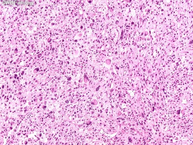 This histopathology image depicts a prostatic malignant mesenchymal neoplasm consistent with undifferentiated pleomorphic sarcoma (formerly malignant fibrous histiocytoma). Acquired from prostate tissue and stained with Hematoxylin and Eosin, the section shows high cellularity with marked nuclear pleomorphism and bizarre multinucleated tumor giant cells scattered haphazardly within a variably fibrous stroma. Tumor cells range from spindle-shaped to polygonal, with hyperchromatic, irregular nuclei and conspicuous nucleoli; cytoplasm is sometimes abundant and vacuolated. Notably, there is an absence of a classic storiform-pleomorphic growth pattern; cells are arranged in diffuse sheets without a defined fascicular architecture. Immunophenotype, based on the described panel, shows positivity only for vimentin, with lack of epithelial (cytokeratin, EMA), muscle (desmin, smooth muscle actin), melanocytic, or neural markers, supporting a diagnosis of a high-grade, undifferentiated sarcoma. Clinically, prostatic UPS is rare and aggressive, requiring immunohistochemical confirmation and exclusion of sarcomatoid carcinoma. Diagnostic significance lies in separating mesenchymal prostatic neoplasms from epithelial malignancies; differential diagnoses include sarcomatoid carcinoma, rhabdomyosarcoma, leiomyosarcoma, and other pleomorphic sarcomas. This image is educational for pathology grading, differential diagnosis, and correlating histology with prognosis and therapeutic planning.
