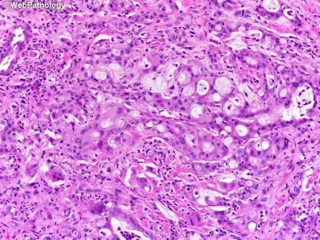 Histopathology image of prostatic tissue stained with Hematoxylin and Eosin (H&E) at high magnification. The specimen demonstrates two divergent neoplastic components: poorly formed glands with intraluminal mucin representing glandular/prostatic adenocarcinoma, and an adjacent region of moderately differentiated squamous cell carcinoma (visible in the upper right). The glandular glands show architectural distortion, nuclear atypia, prominent nucleoli, and mitotic activity within a mucin-rich luminal compartment. The intraluminal mucin is variably distended and characteristically aligns with dysplastic glandular epithelium. The squamous component displays nests of keratinizing polygonal cells, intercellular bridges, and moderate cytologic atypia consistent with squamous differentiation. Immunohistochemistry (PSA and prostatic acid phosphatase [PAP]) shows strong, diffuse positivity in the glandular areas, confirming prostatic origin, while the squamous component is negative for PSA and PAP, supporting a divergent differentiation lineage. These findings indicate an adenosquamous (mixed) carcinoma of the prostate or a prostatic adenocarcinoma with squamous differentiation. Clinically, this histology implies heterogeneity with potential implications for prognosis and treatment, as squamous differentiation can be less responsive to androgen deprivation therapy. Differential diagnosis includes non-prostatic mucin-producing adenocarcinomas, metastasis, or sarcomatoid carcinoma; correlation with clinical history and additional markers is recommended for definitive classification.