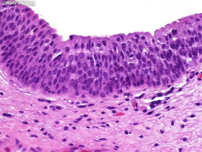 Imaging modality: light microscopy of a hematoxylin and eosin (H&E) stained histology section of bladder wall mucosa. Primary subject is the urothelium (transitional epithelium) lining the urinary bladder, with underlying lamina propria and, deeper, muscularis propria (detrusor muscle). The section depicts a cross-sectional view of the bladder mucosa in which urothelial cells form a multi-layered, stratified lining whose thickness varies with bladder distension. Superficial umbrella cells are present at the luminal surface, with rounded to slightly flattened cytoplasm and prominent nuclei; underlying intermediate and basal cells show orderly alignment and clear basement membrane orientation. The lamina propria appears as loose connective tissue containing scattered inflammatory cells and small vessels; muscularis propria is seen deeper as circular and longitudinal smooth muscle bundles. No overt cytologic atypia or invasion is evident in this normal specimen. Clinically, this histologic pattern provides a reference standard for normal urothelium, enabling recognition of pathological changes such as urothelial hyperplasia, dysplasia, carcinoma in situ, or invasive urothelial carcinoma when atypia or architectural disarray is present. Diagnostic significance includes distinguishing normal distension-related variability from disease states; differential considerations include inflammatory/reactive changes and neoplastic processes. This image is educational for medical students, residents, and researchers studying bladder histology and urothelial pathology.