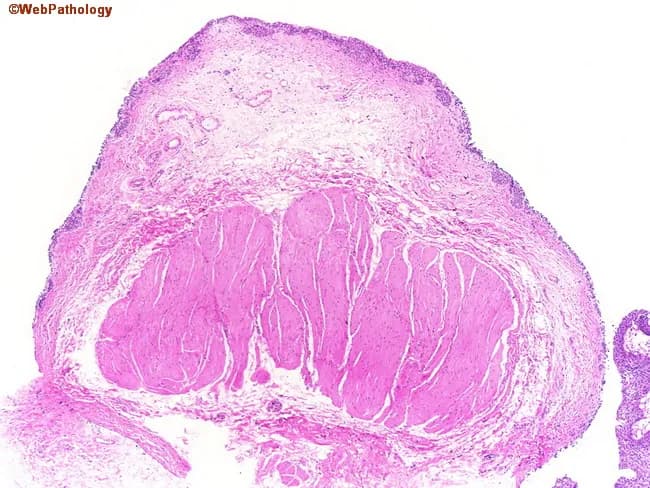 Low-magnification light microscopic image of a section through the urinary bladder wall stained with Hematoxylin and Eosin. The mucosal surface is out of focus at the top, revealing urothelium transitioning into the lamina propria and then into the muscularis propria. The detrusor muscle, comprising thick, densely packed smooth muscle bundles, dominates the deeper aspect of the wall. In contrast, the muscularis mucosae is represented by wispy, discontinuous fascicles more superficially, making the distinction between muscularis propria and mucosa identifiable yet challenging in small specimens. The detrusor fibers are arranged in interlacing and parallel orientations with brisk eosinophilic cytoplasm and elongated, spindle-shaped nuclei; connective tissue septa are sparse in this field. Variation in thickness and organization is evident, with the region near the bladder neck showing coarser, more tightly packed bundles compared with more distal bladder segments. Although this image does not show neoplastic invasion, understanding the architecture is critical for accurate bladder cancer staging. In practice, invasion of the muscularis propria (detrusor) would denote stage T2 disease, driving definitive treatment such as radical cystectomy or radiation therapy. This slide illustrates normal histologic landmarks that underlie diagnostic decision-making, sampling adequacy, and staging accuracy in urothelial carcinoma. For clinical and research use.