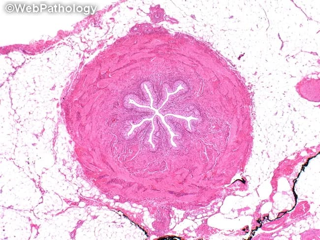 Imaging modality and technique: Bright-field light microscopy on a formalin-fixed, paraffin-embedded tissue section stained with Hematoxylin and Eosin (H&E). Specimen shows a transverse cross-section of a vascular structure within subcutaneous adipose and connective tissue. Anatomical context: vascular tissue from soft tissue; a small to medium-sized muscular artery or arteriolar segment; wall demonstrates layered tunica media with concentric lamination, an intact adventitia, and a single patent lumen visible as a bright white cavity. The lumen appears narrowed by inward folding of the intima and by mural thickening, while surrounding adipose tissue provides a pale pink backdrop. Notable features include radiating inward extensions within the lumen that may reflect physiologic folds or artifact from sectioning, not true septa. Normal variants such as mural elasticity and preserved architectural organization are evident; no dense inflammatory infiltrate, necrosis, or calcification is clearly seen. Diagnostic significance is limited by single high-magnification view; if clinically indicated, this finding could correspond to normal vascular morphology, hypertensive arteriopathy, or early atherosclerotic change depending on additional context. Clinical correlation with age, blood pressure, lipid status, and history of cardiovascular disease is recommended. This image is relevant for education on vascular histology and for differential diagnosis in soft-tissue pathology. Educational use.